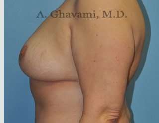 Procedure before and after - after