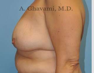 Procedure before and after - before