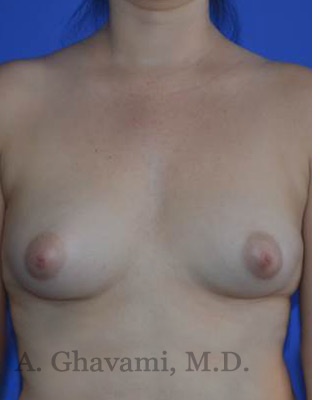 Procedure before and after - before