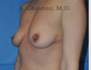 Procedure before and after - before