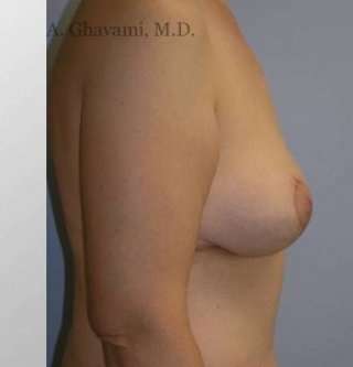 Procedure before and after - after