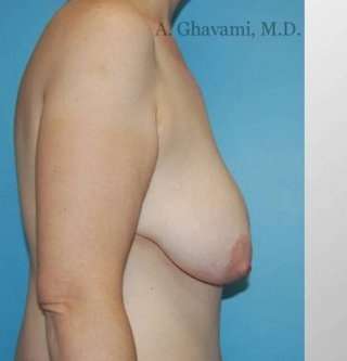 Procedure before and after - before