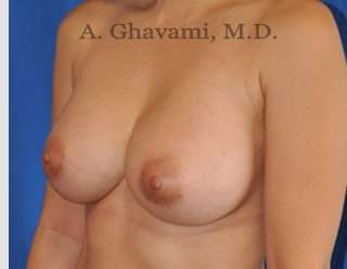 Procedure before and after - after