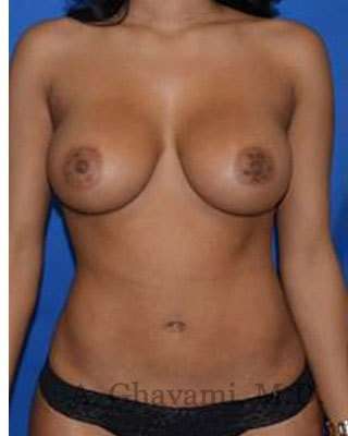 Procedure before and after - after