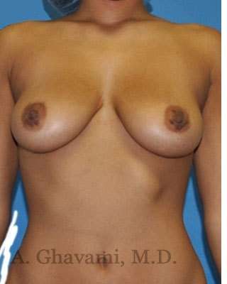 Procedure before and after - before