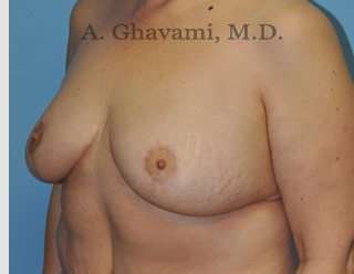 Procedure before and after - after