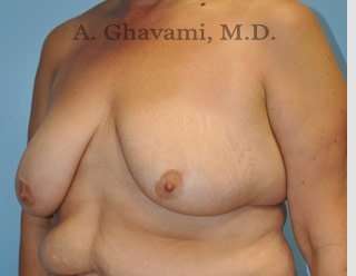 Procedure before and after - before
