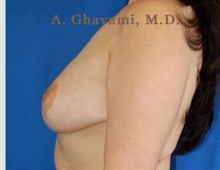 Procedure before and after - after