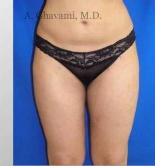 Liposuction before and after - after