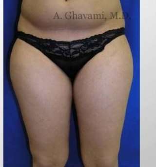 Liposuction before and after - before