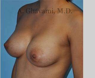 Procedure before and after - after