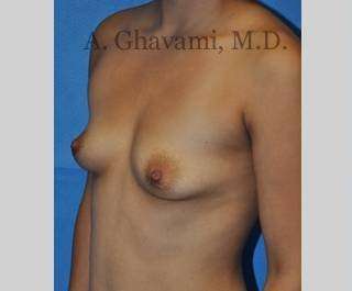 Procedure before and after - before