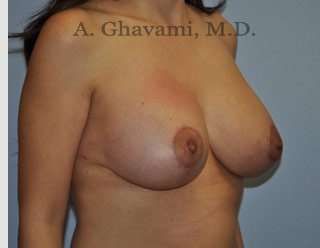 Procedure before and after - after