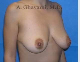 Procedure before and after - before
