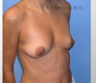 Procedure before and after - before