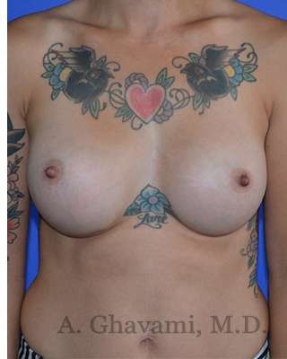 Procedure before and after - after