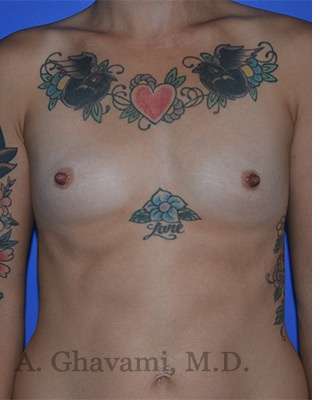Procedure before and after - before