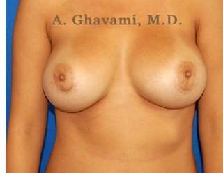 Procedure before and after - after