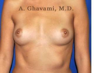 Procedure before and after - before
