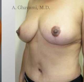 Mommy Makeover before and after - after