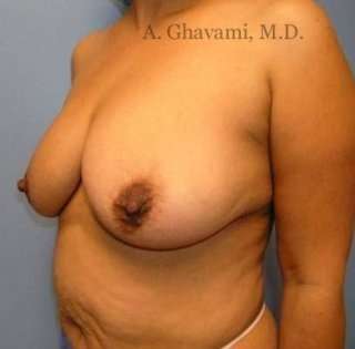 Mommy Makeover before and after - before
