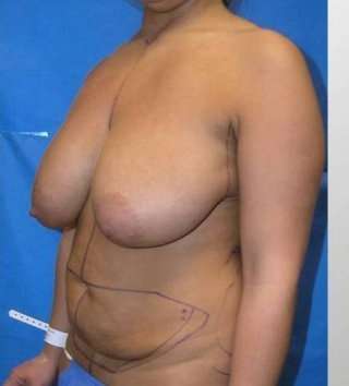 Mommy Makeover before and after - before