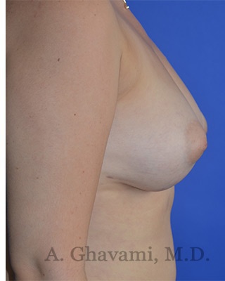 Procedure before and after - after