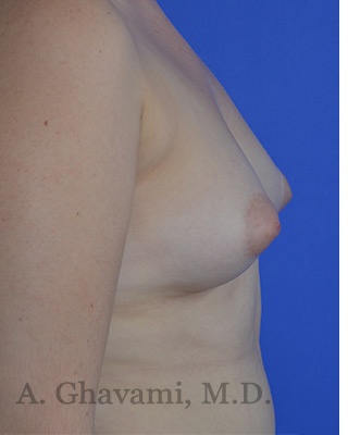Procedure before and after - before