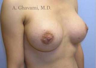 Procedure before and after - after