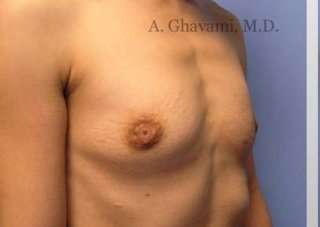 Procedure before and after - before