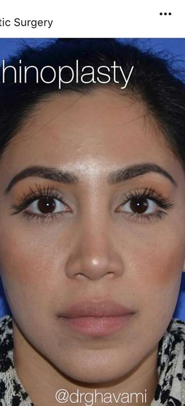 Rhinoplasty before and after - after