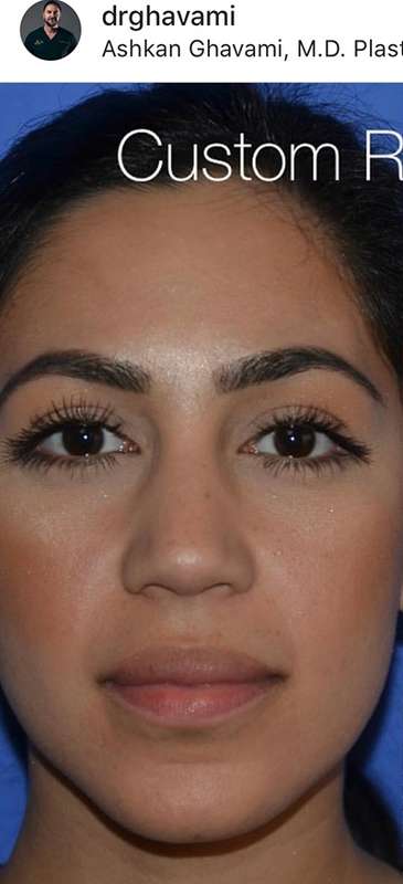 Rhinoplasty before and after - before