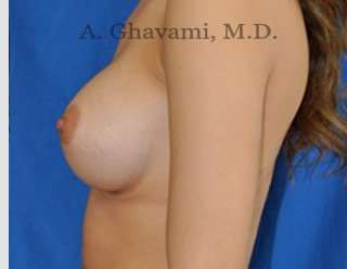 Procedure before and after - after