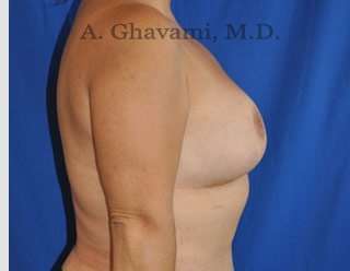 Procedure before and after - after