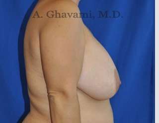 Procedure before and after - before