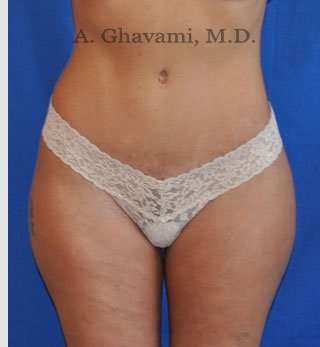Tummy Tuck before and after - after