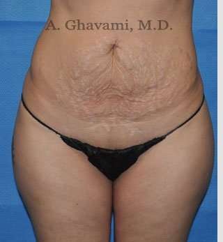 Tummy Tuck before and after - before