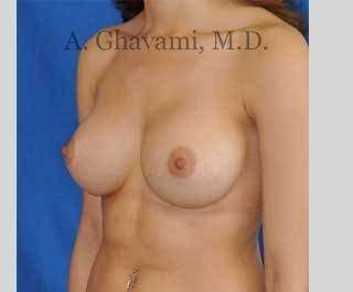 Procedure before and after - after