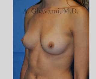 Procedure before and after - before