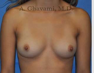 Procedure before and after - before