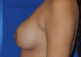 Procedure before and after - after