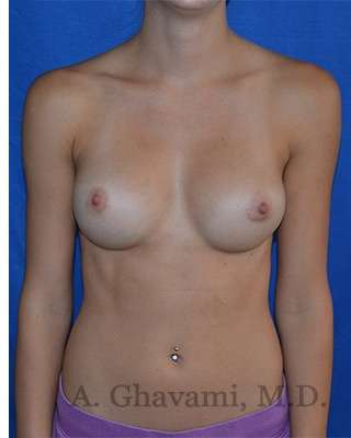 Procedure before and after - after