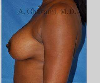 Procedure before and after - after