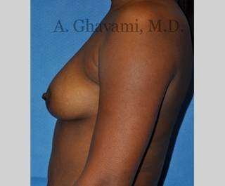 Procedure before and after - before