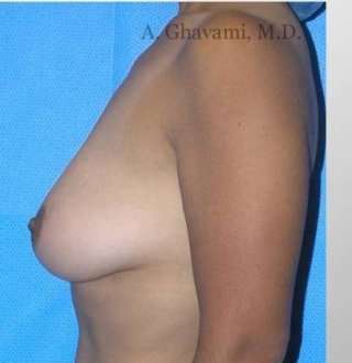 Procedure before and after - before