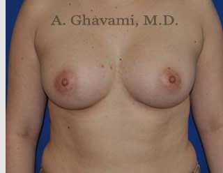 Procedure before and after - after