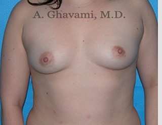 Procedure before and after - before