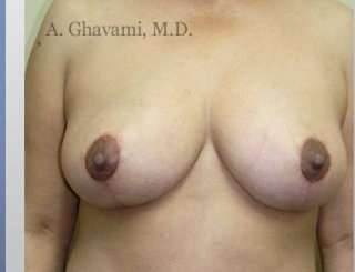 Procedure before and after - after