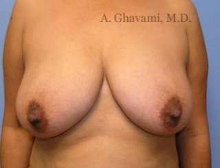 Procedure before and after - before