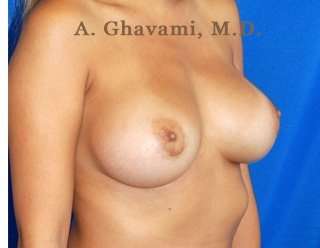 Procedure before and after - after